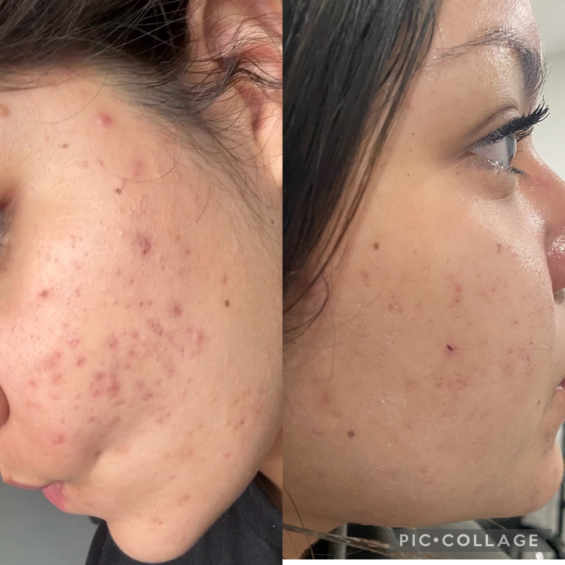 Acne Facial Bootcamp