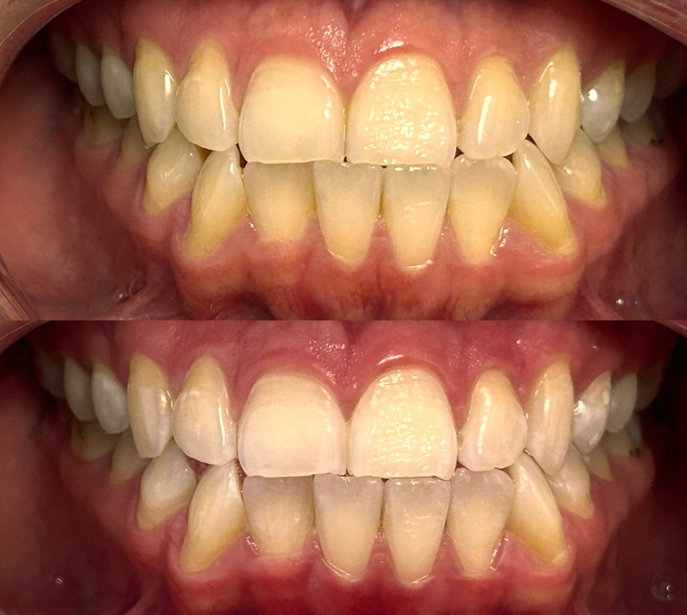 30 Minute Whitening Session