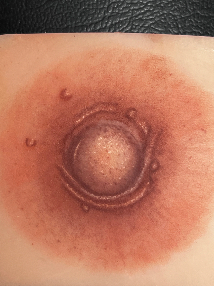 Areola Nipple Reconstruction