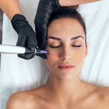 Microneedling at Amy Donaldson Nurse Injector in Westport, MA