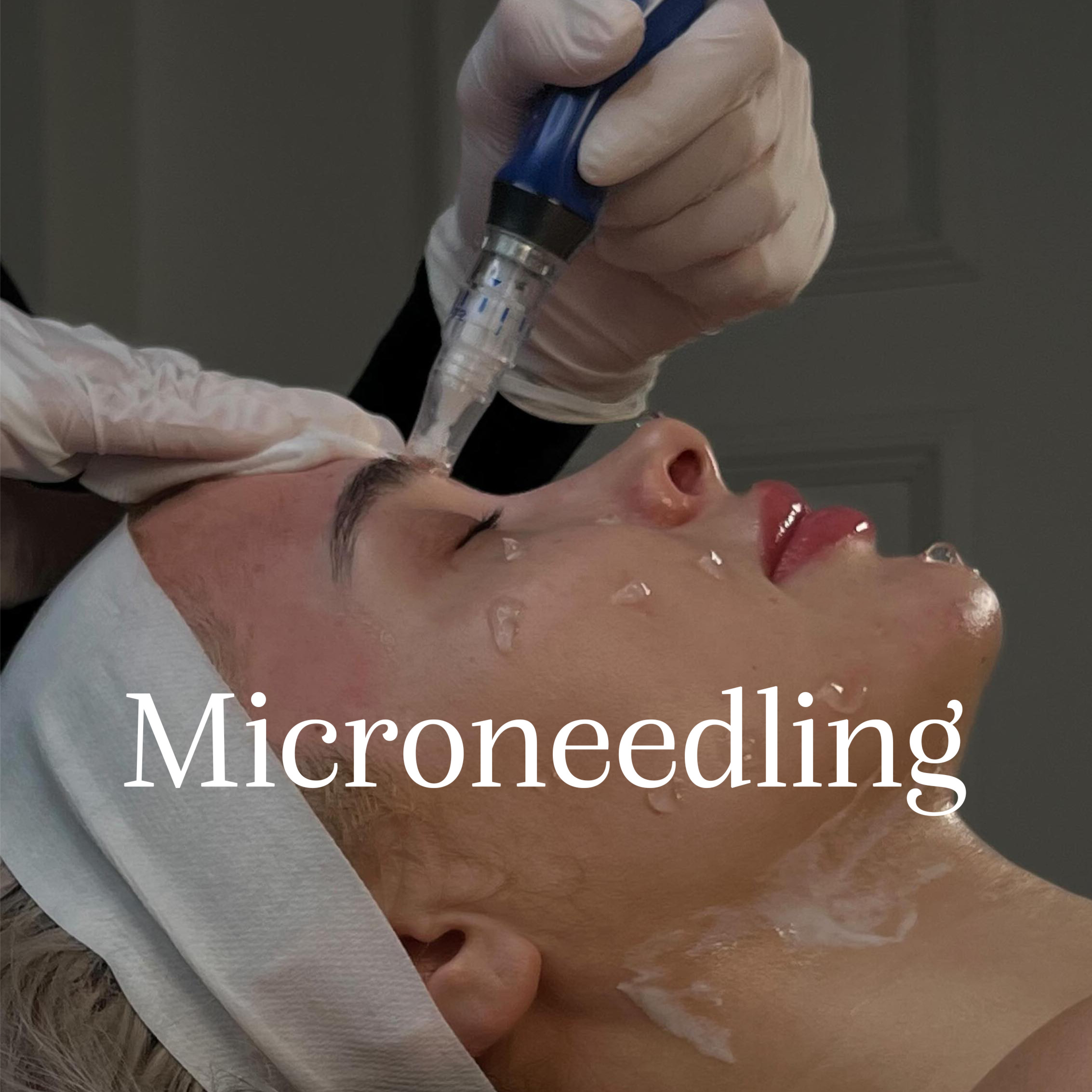 MICRONEEDLING TREATMENT