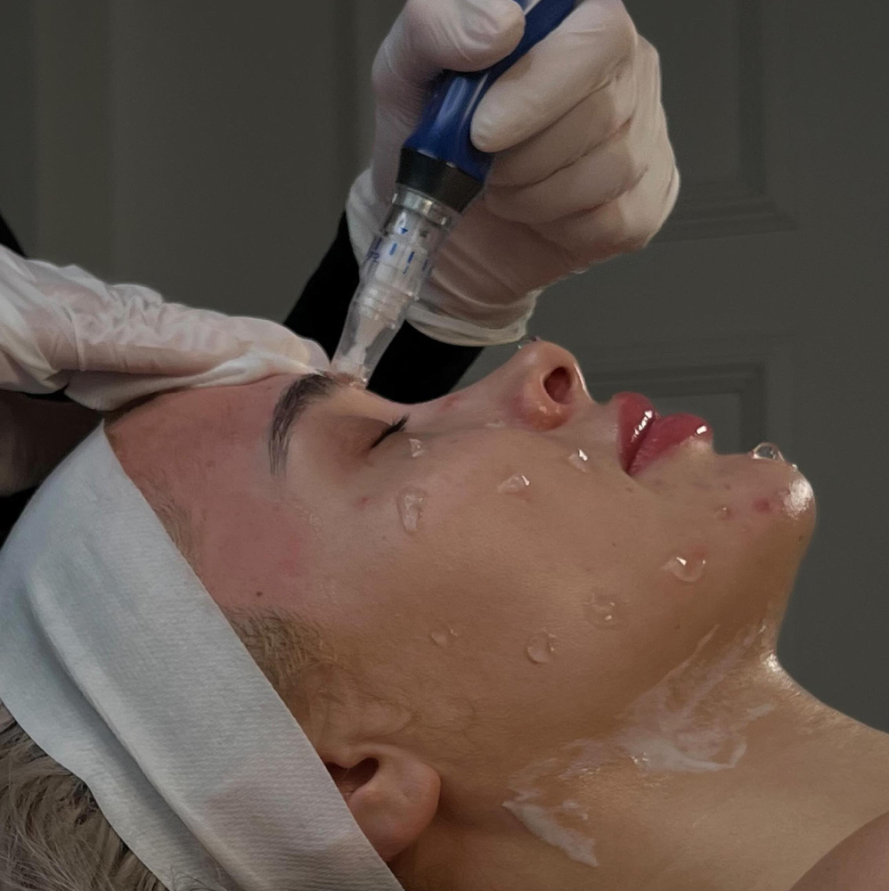MICRONEEDLING TREATMENT