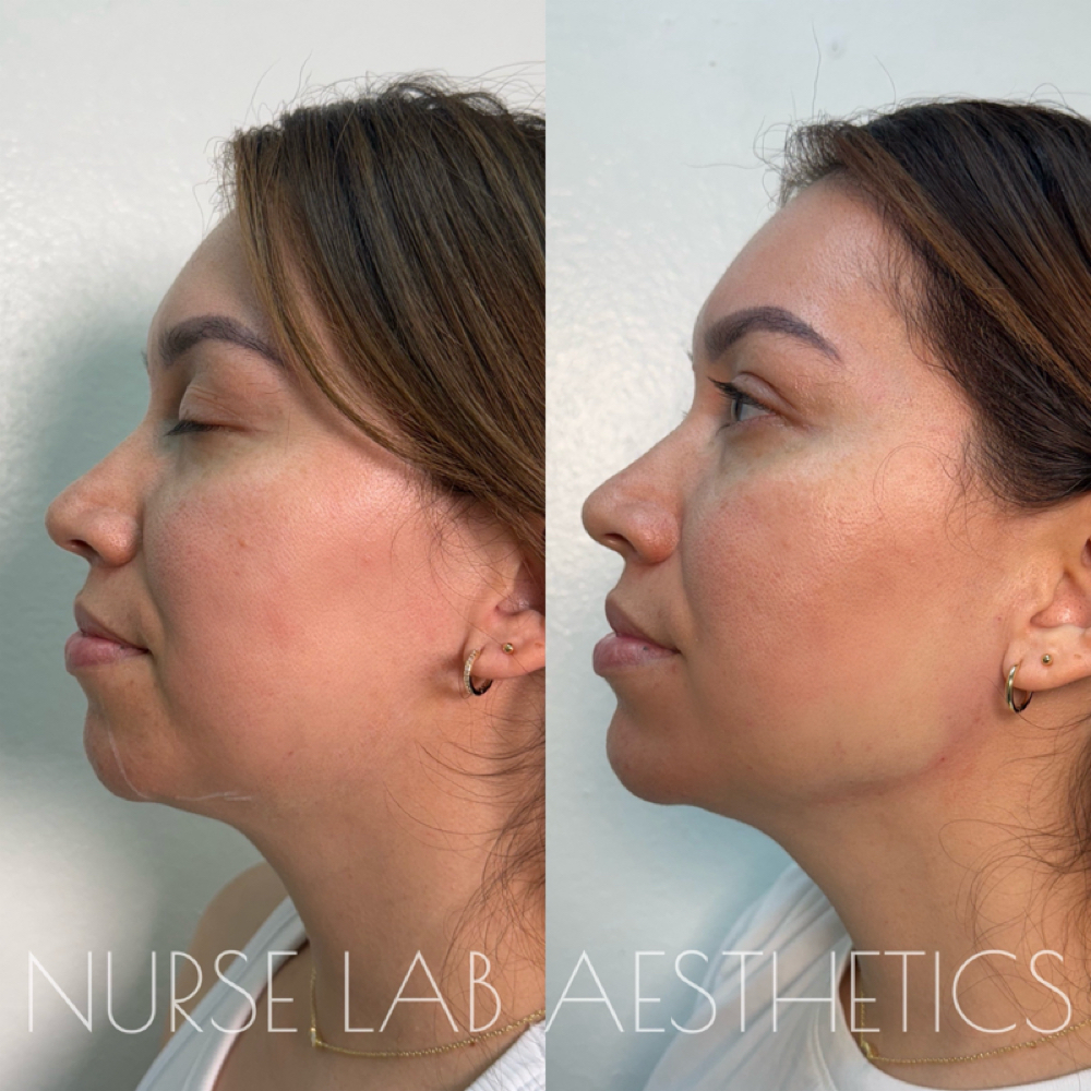 Facial Balancing at Nurse Lab Aesthetics & Wellness in Mission, TX
