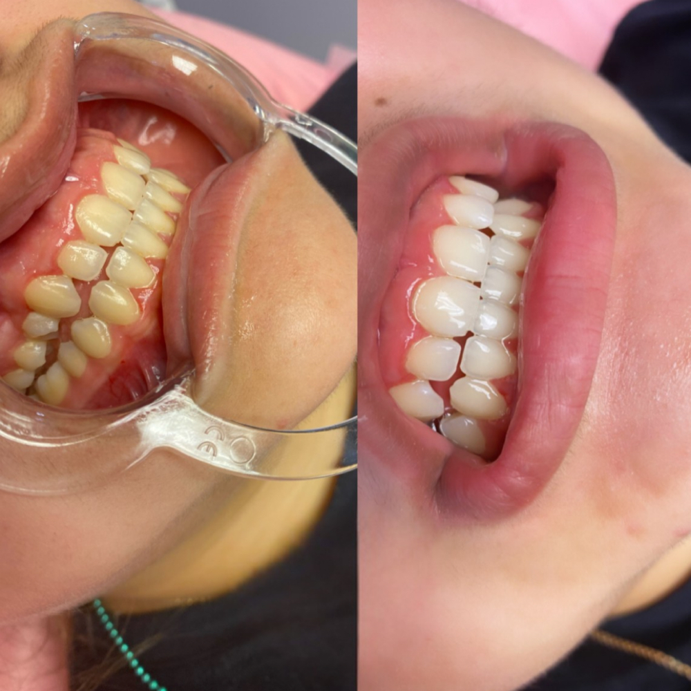 Teeth Whitening at Lilli Aesthetics LLC in Mansfield, TX