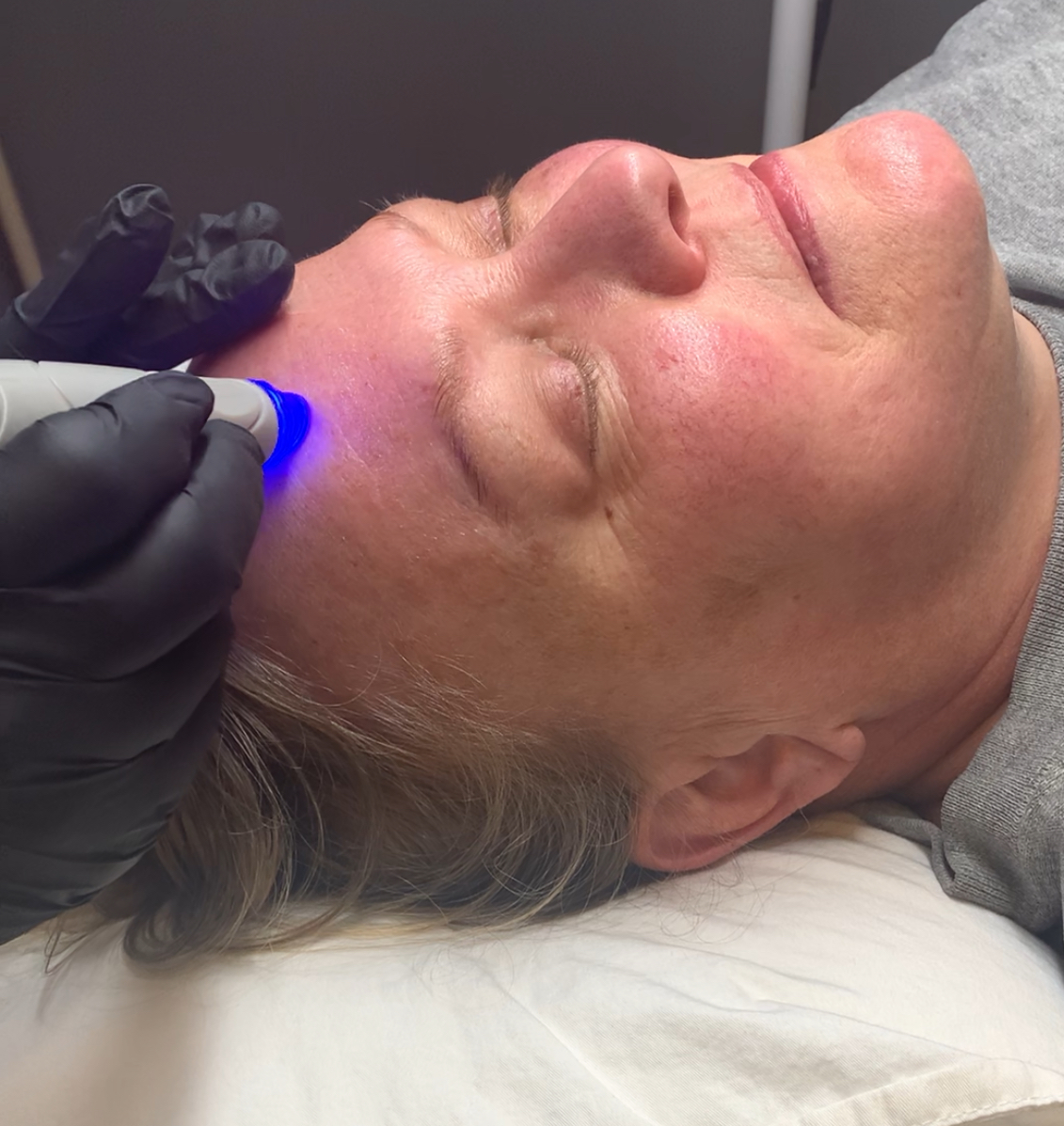 Hydrafacial