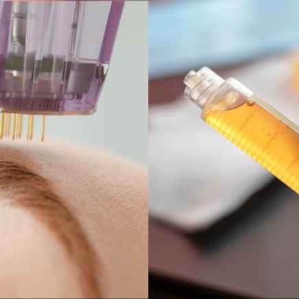 Microneedling with PRP (3 sessions) at M.LO aesthetics + wellness in Waukesha, WI