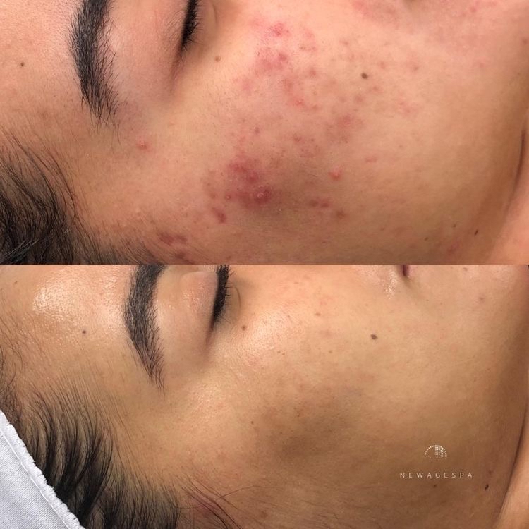 Micro Needling Full Face