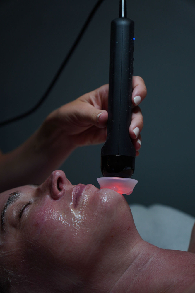 Radio Frequency Treatment or Add On