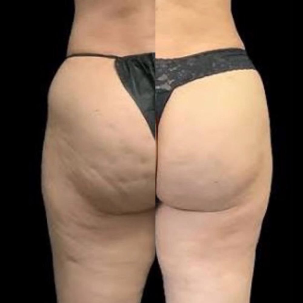 "Cellulite Derrière Enhancement" at A Touch of Class Body-Sculpting in Brentwood, CA