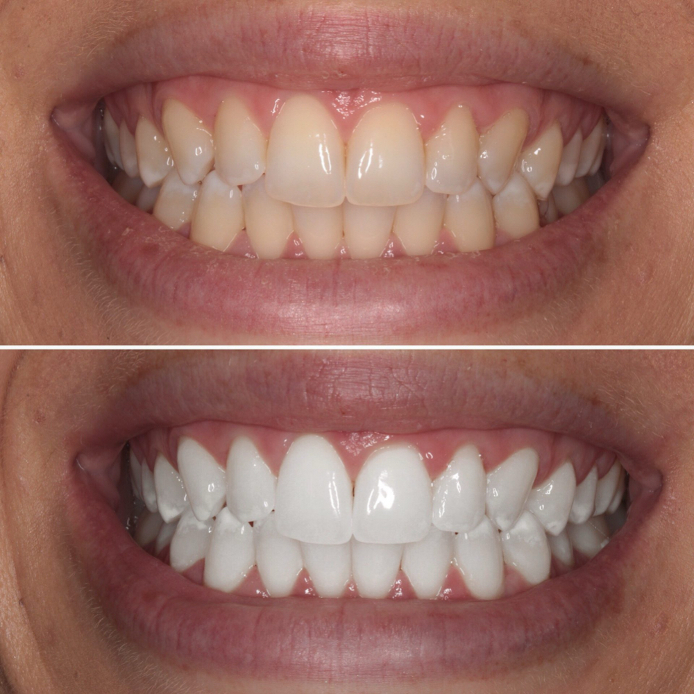 Teeth Whitening at Glam and Glow in Huffman, TX