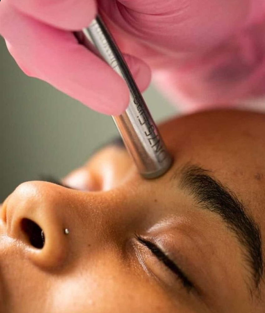 Fixer Upper ( Microdermabrasion)