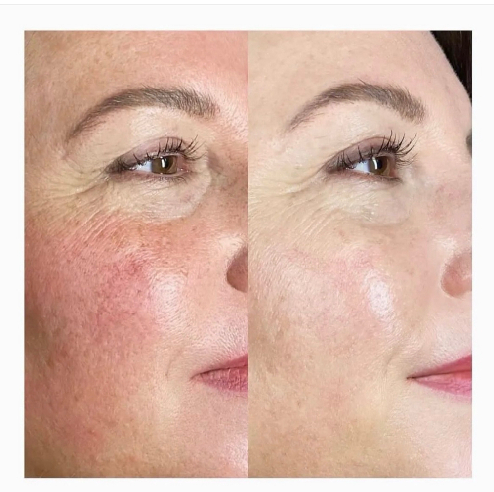 Perfect Pure Peel with PDRN+ at XO Skincare by Jeane Richmond in Norwalk, CT