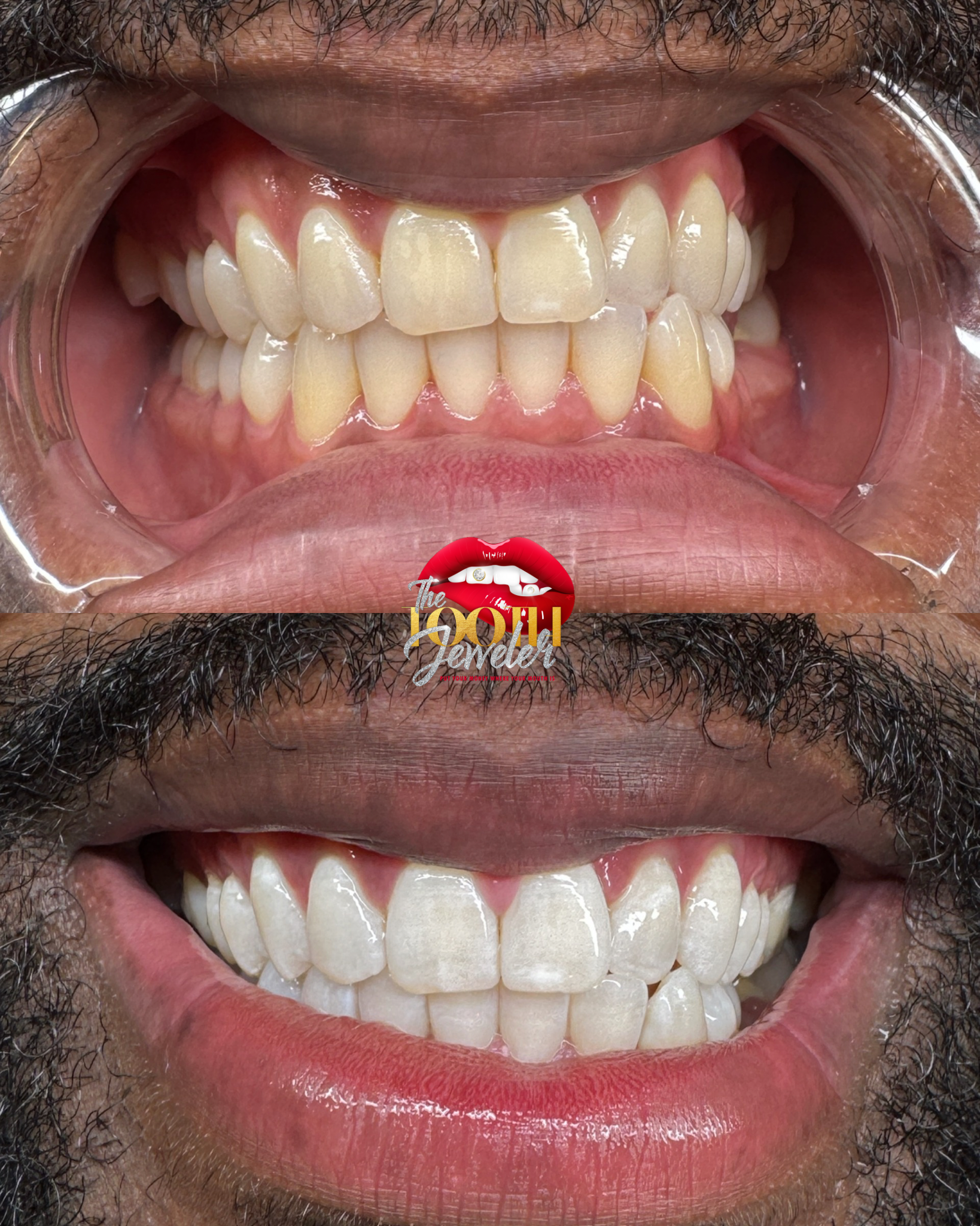 Teeth Whitening Sessions