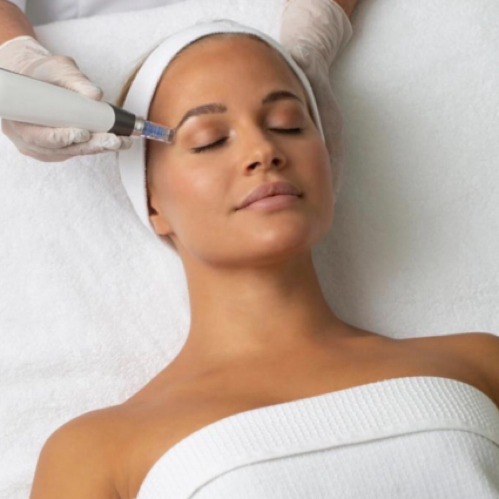 RF Microneedling Face+Neck package at Sunshine Esthetics Lounge in Lake Mary, FL