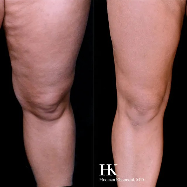 Skin Rejuvenation Thigh