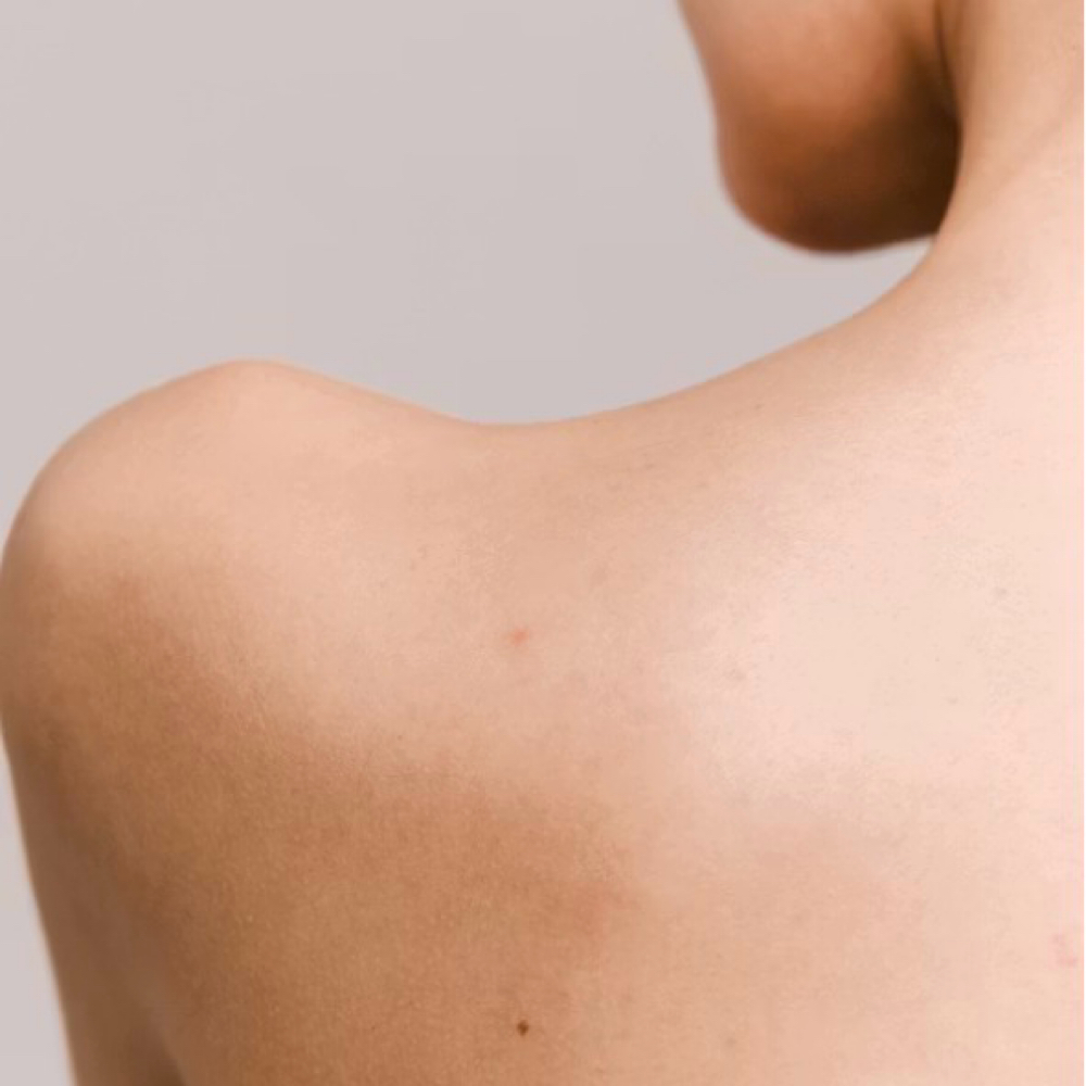Half Back / 6 Sessions at EverBeauty Laser & Aesthetics in Argyle, TX
