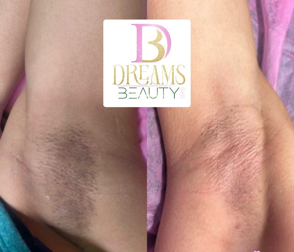 Underarm Bleaching