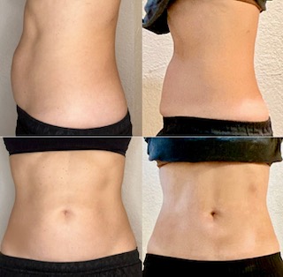 PCDC/Lipodissolve