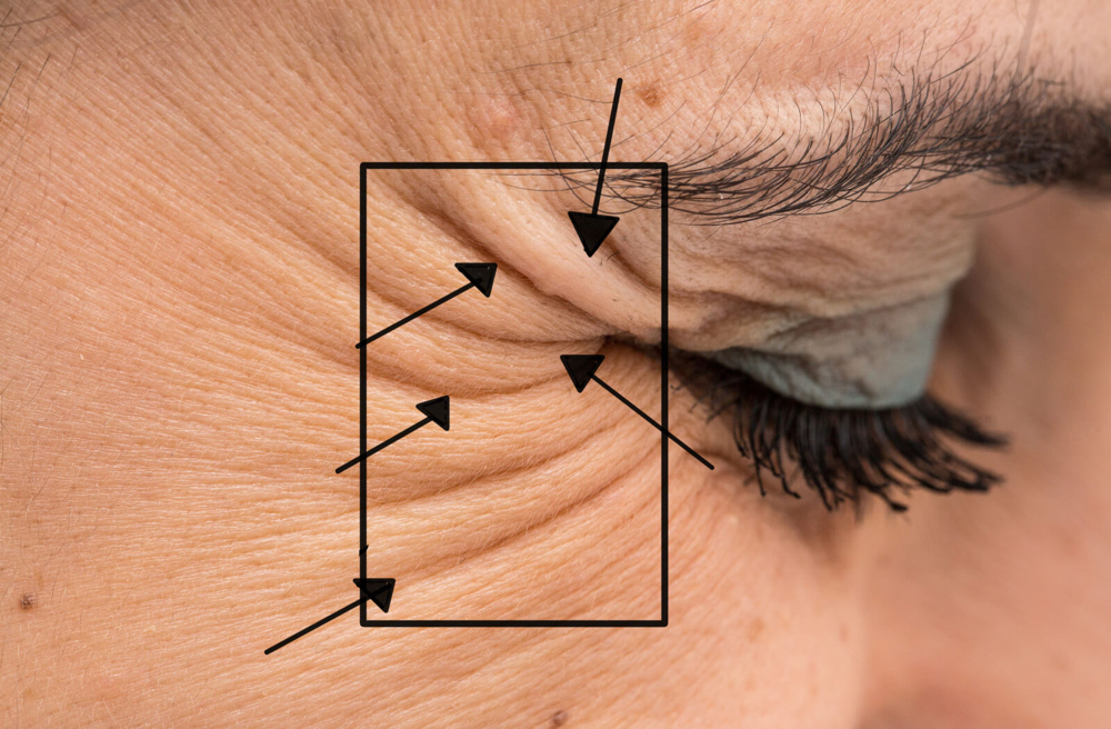 Botox- Crows Feet