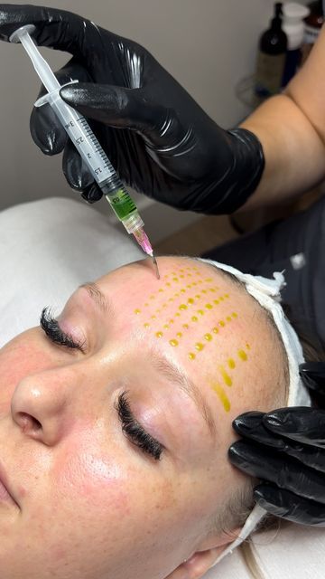 CHEMICAL PEEL