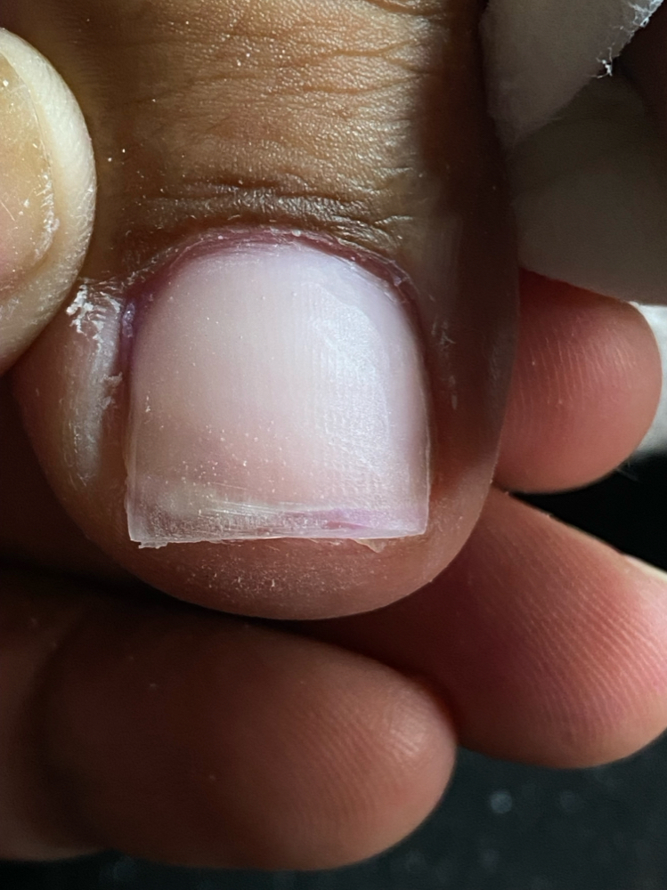 Acrylic On Toe