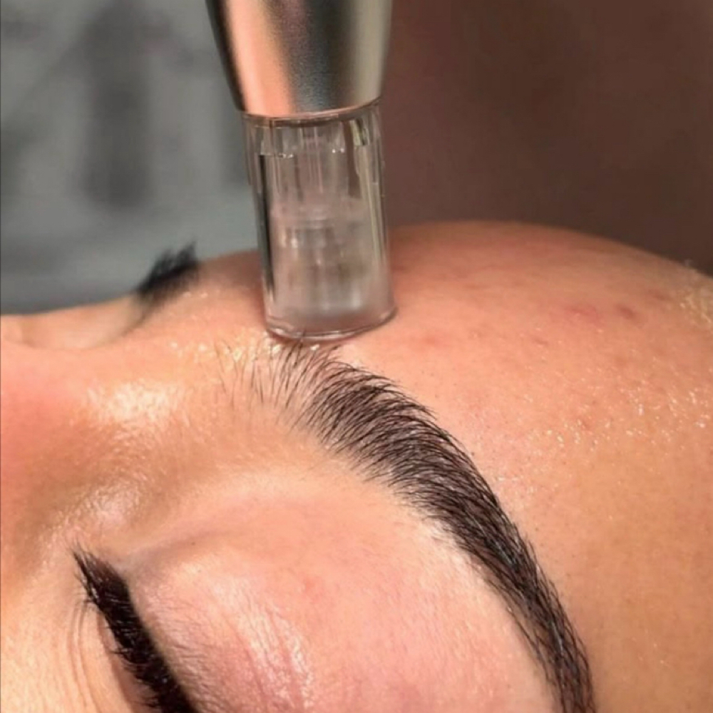 ‘Just’ Major-Needling at Skinfession Esthetics by Mayci in University Place, WA