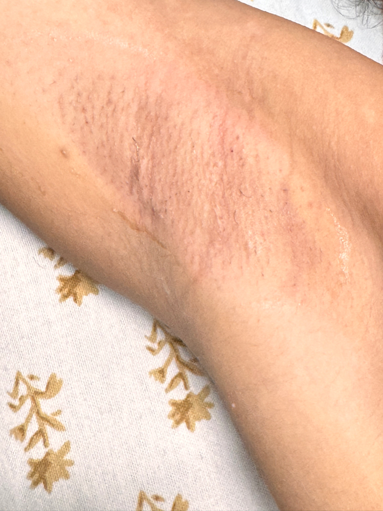 Underarms