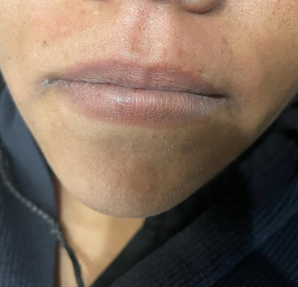 Upper Lip Hair Removal