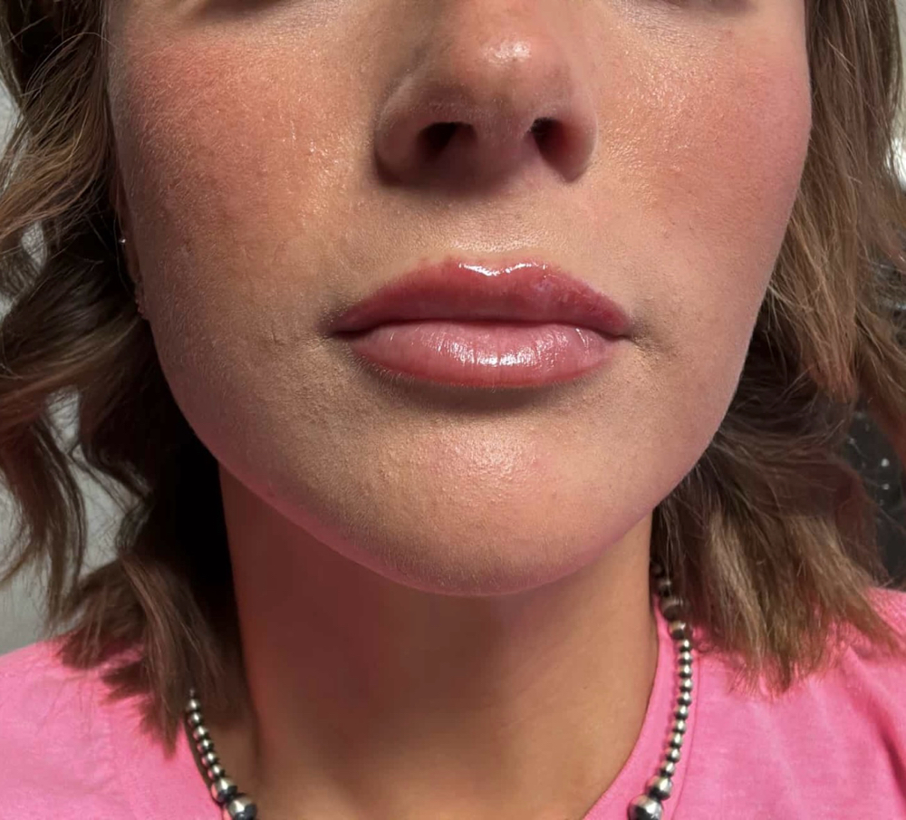 1/2 Syringe of Lip Filler