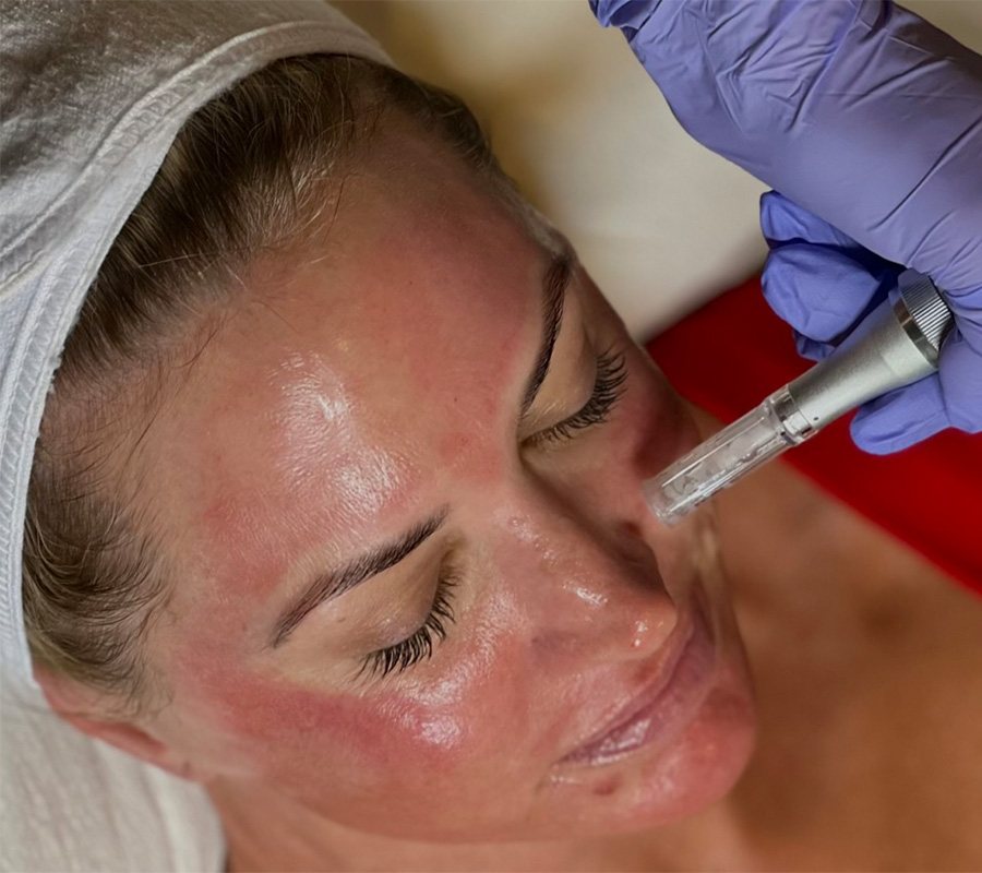 Microneedling