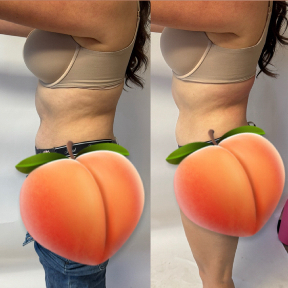 Body Contouring at Olympus Beauty Studios in Tucson, AZ