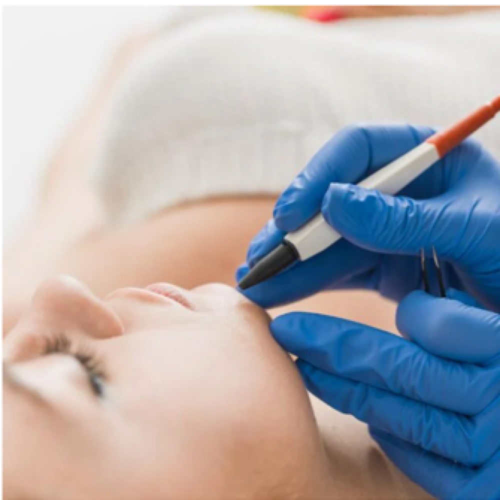 Electrolysis at Aura Electrolysis | Laser | Threading in Ashland, MA