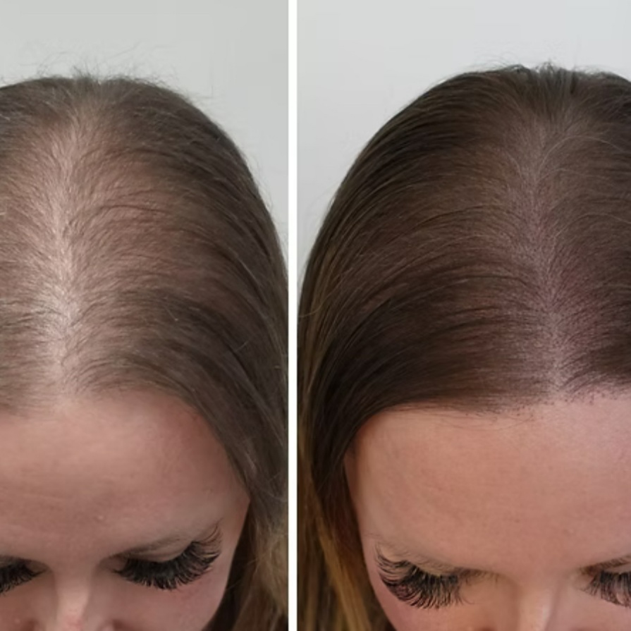 Scalp Micropigmentation