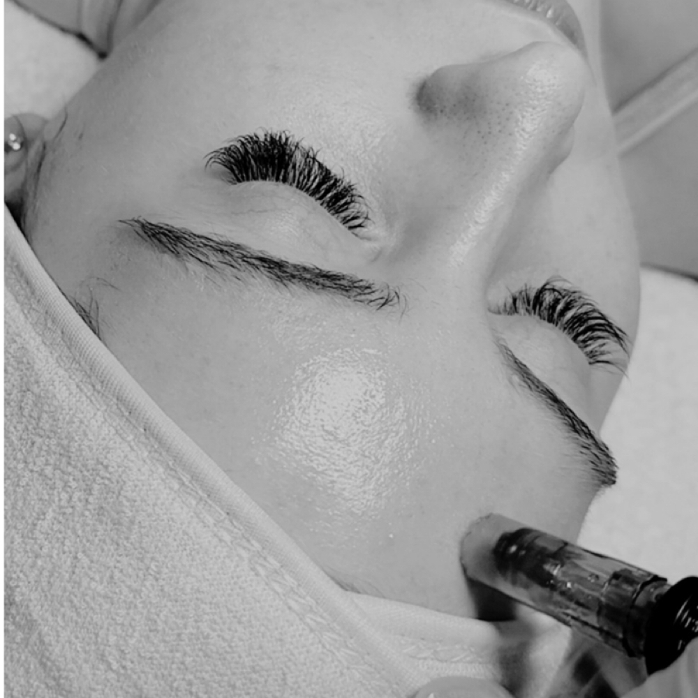 Microneedling Body Package at Bare Aesthetics By Chloe in Lake Norman of Catawba, NC