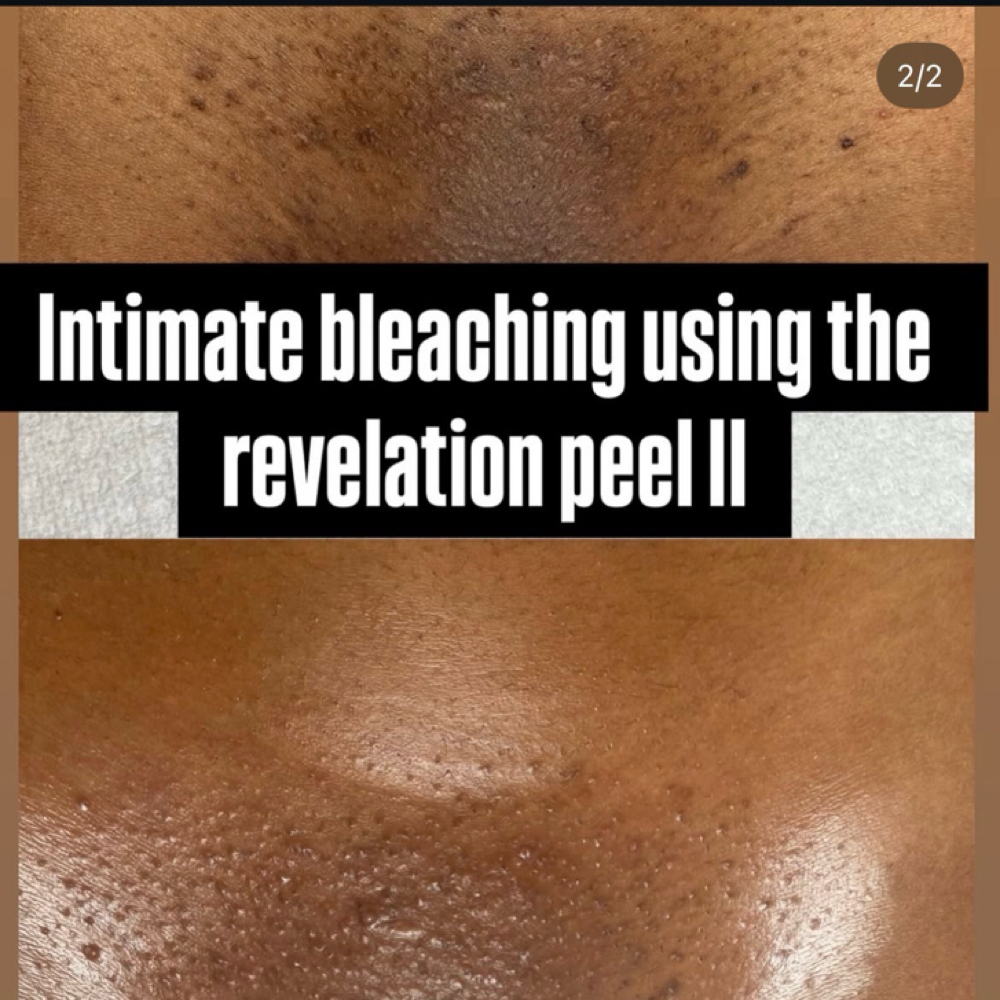 Intimade Skin Lightning at Emerald Beauty in Anna, TX