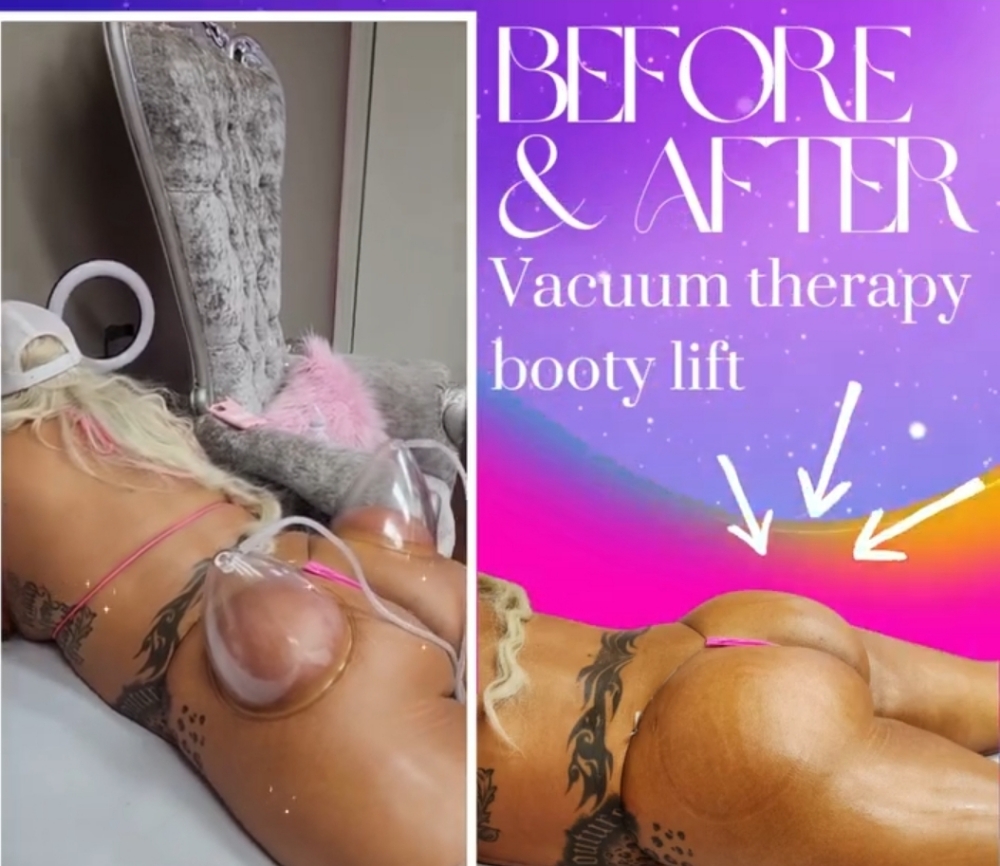 Vacuum Therapy Booty Lift at Beauty2you in Visalia, CA