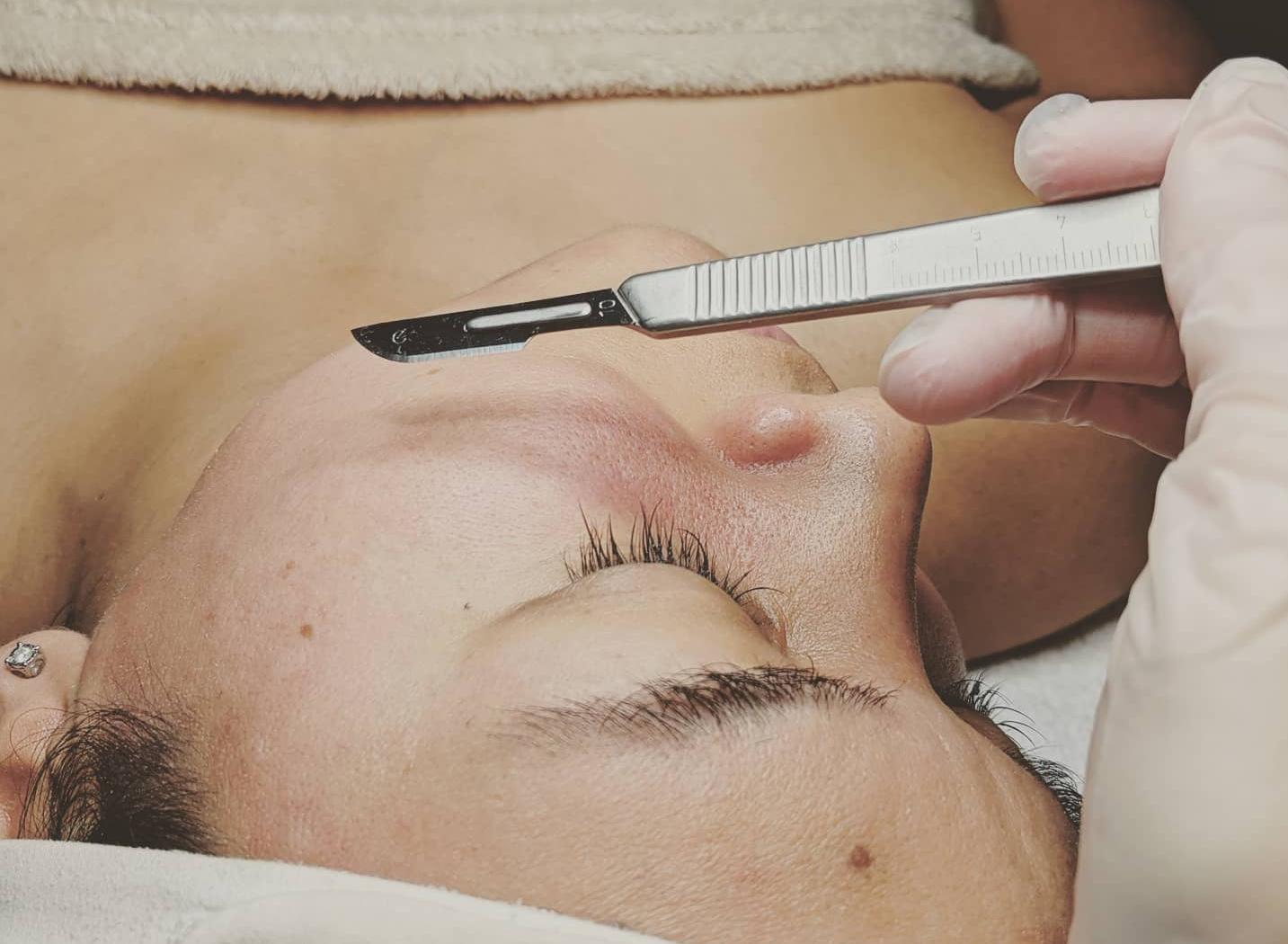 Dermaplanning treatment