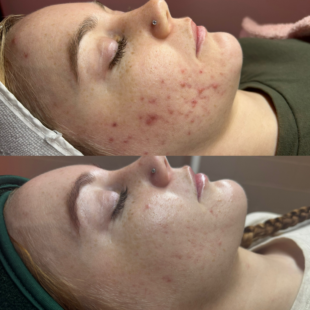 Virtual Acne Check In