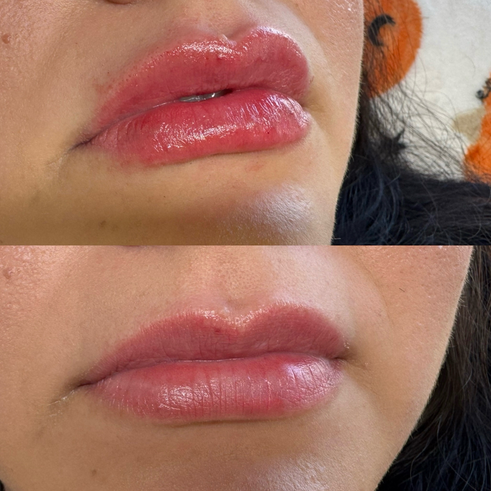 Microneedle Lip Filler Special