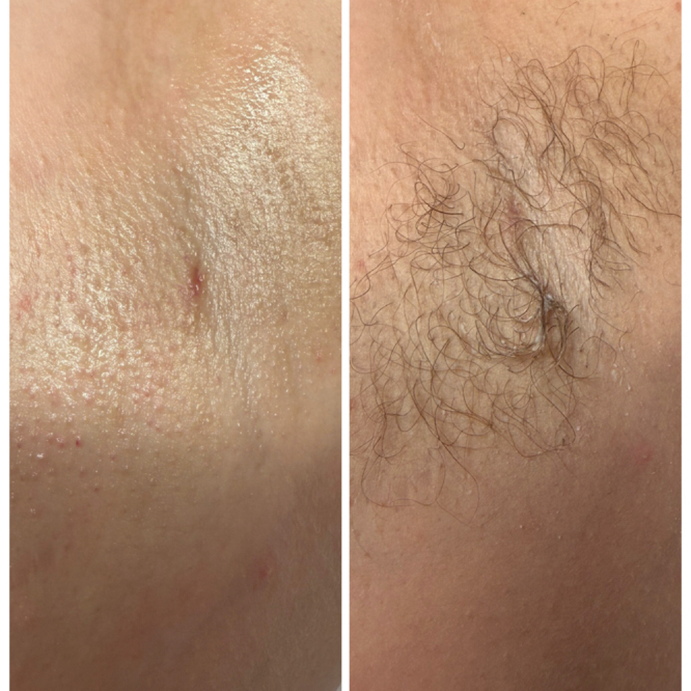 Underarm Wax at The Happy Hippie Esthetician in Roscoe, IL