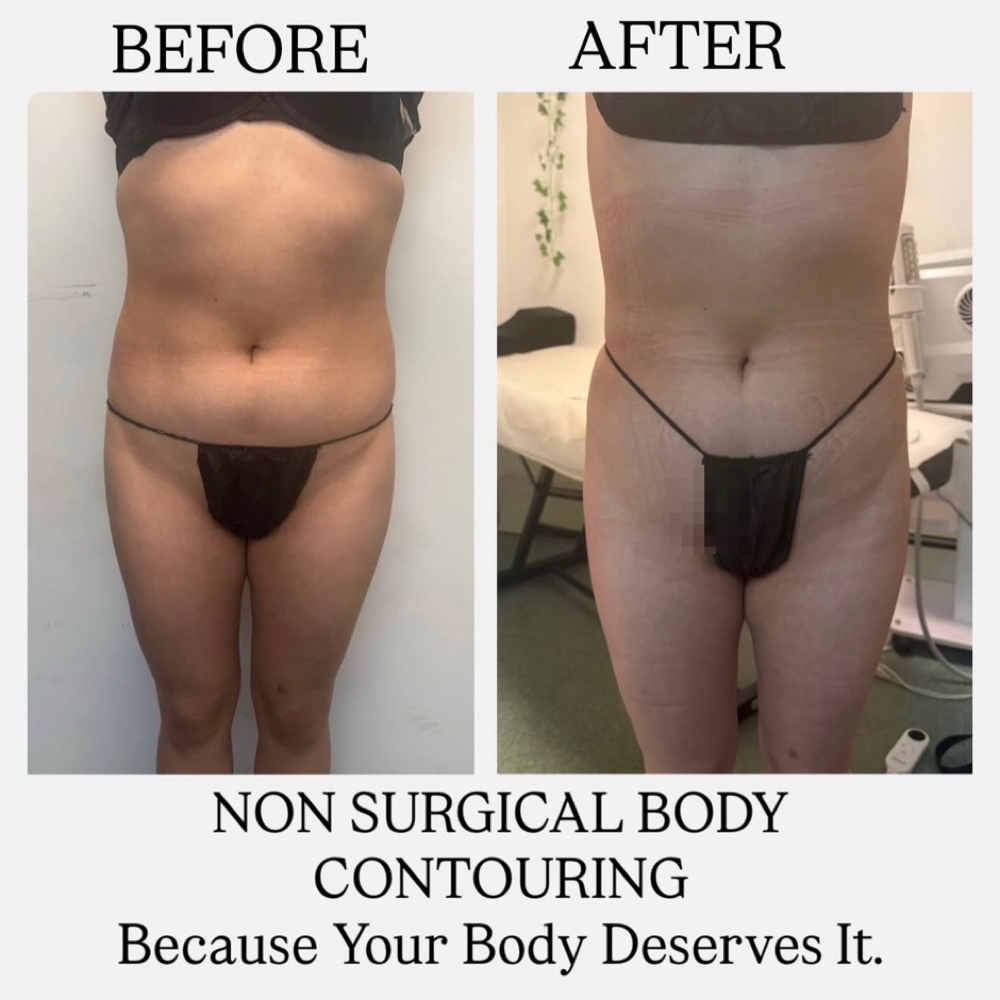 Body Contour at Any Beauty Aesthetics Care in New York, NY