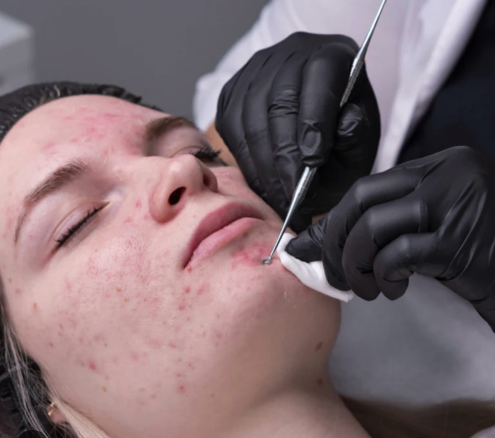Acne-Facial at Skintique by lacey in Dayton, OH