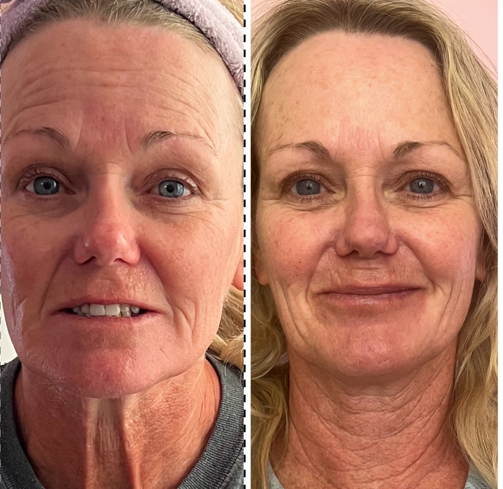 Cryoskin Facelift Facial