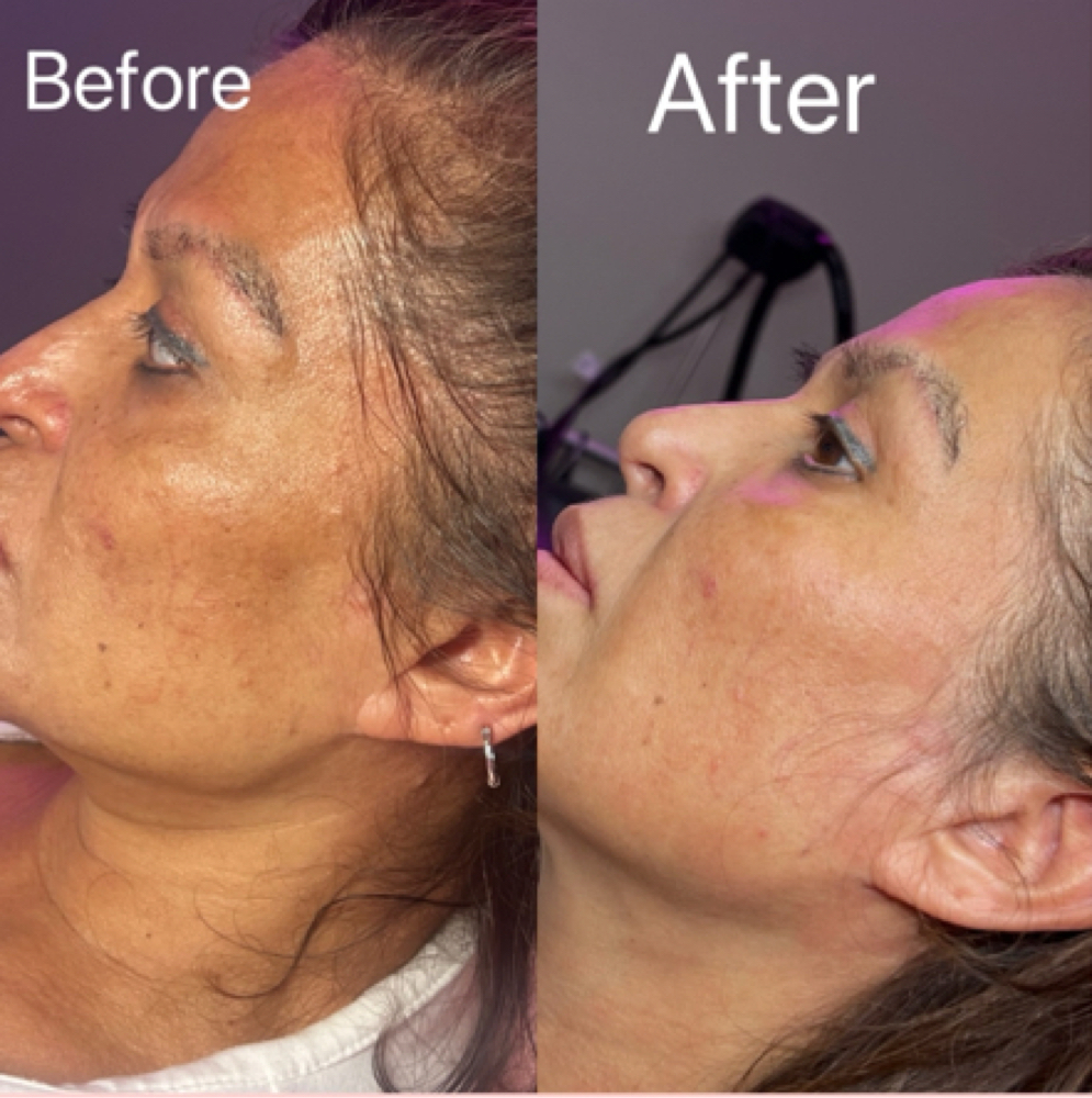Nanofractional Skin Resurfacing at Flawless Spa & Beauty in Fort Worth, TX
