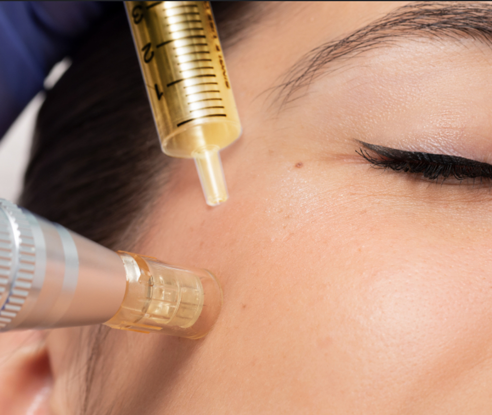 Microneedling