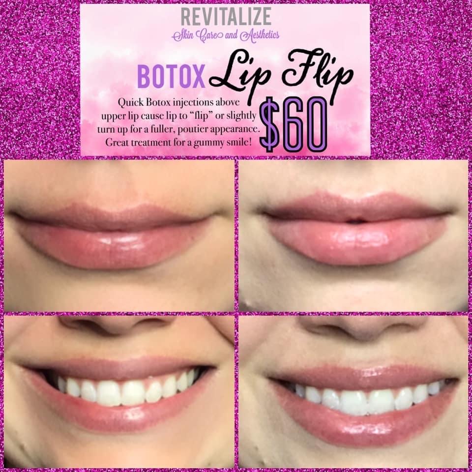 Botox Lip Flip