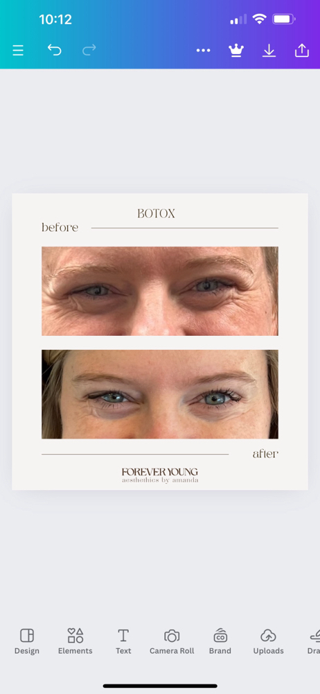 Botox