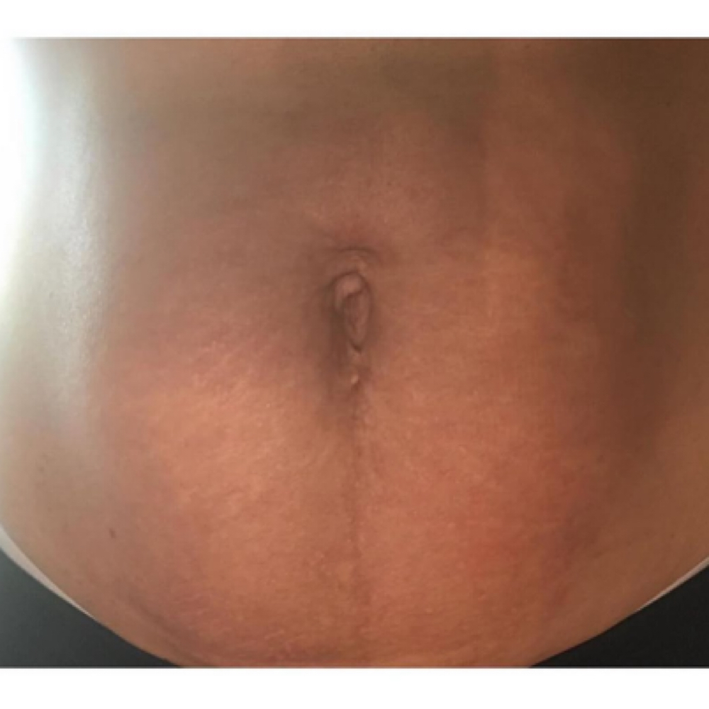 Fibroblast -Belly at Skin Fixation & Esthetic Training in Port Saint Lucie, FL