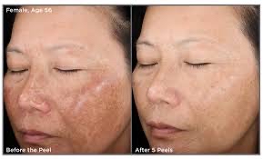 SkinMedica Chemical Peels