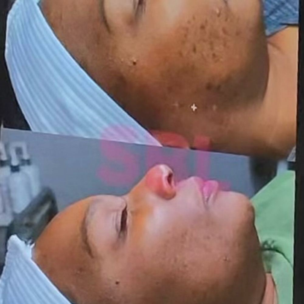 Organo Peel Facial Series (3) at All Set Wax Spa in Miami Gardens, FL